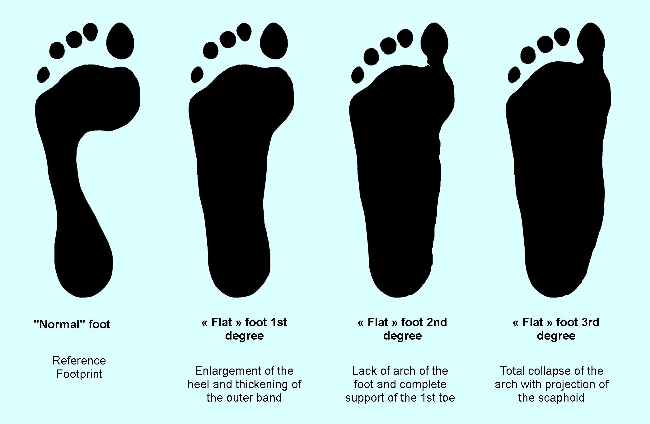 Foot print iin flat feet | Foot 'n' Ankle Clinic Kochi Kerala